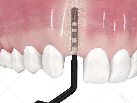 植入种植体全过程,看的你牙齿疼不疼?#健康dou起来 #dou出新知