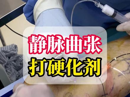 静脉曲张打硬化剂全过程#静脉曲张 #健康