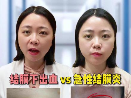 结膜下出血和急性结膜炎有什么不同呢#医学科普 #结膜下出血 #急性结膜炎 #抖出健康知识宝藏