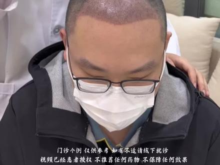 大面积脱发 种植4300单位#发际线#西安医学院第二附属医院毛发门诊 #脱发 #掉发