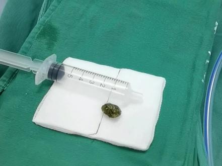 胃肠肝胆肿瘤外科:腹腔镜辅助胆囊取石术#腔镜手术 #腹腔镜 #结石 #胆囊结石