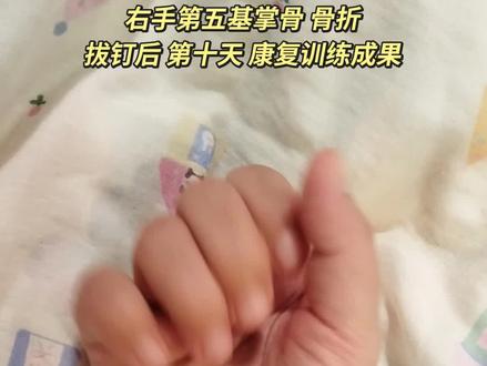 康复训练,加油#骨折 #骨折恢复记录 #手指操作用大 #手指锻炼