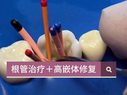 #根管治疗 #高嵌体 #口腔科普 一个视频带你看懂根管治疗全过程和高嵌体修复