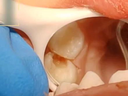 牙洞太深补了也有可能疼,但是只要去净腐质后没有直接露髓,牙齿也没有疼过,x线片看着也正常的,还是建议先保留牙神经,盖髓+严密充填观察,没事最好,就是一颗活髓牙。就算疼了,有症状了再治疗也来得及。#牙医日常 #牙齿 #蛀牙 #牙疼 #硬核健康科普行动