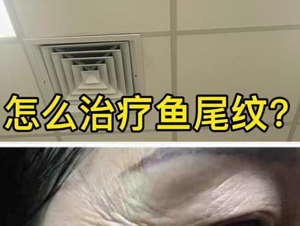 怎么治疗眼角纹(鱼尾纹)?#鱼尾纹 #肉毒