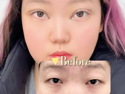 全切双眼皮 | 7mm自然开扇 肿眼泡 大小眼 还原妈生眼
#双眼皮 #洛阳双眼皮 #单眼皮变双眼皮 #自然双眼皮