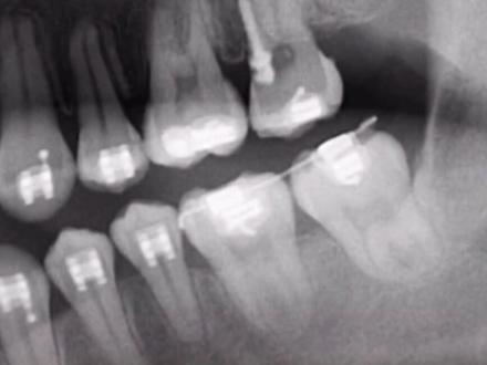 缺牙一定要及时补,要不遭好几年罪#带牙套牙套的日子 #口腔ct图片