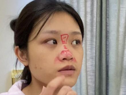 月亮脸拉出面中 #拉面中 #鼻基底凹陷 #面中凹陷 #鼻基底填充 #隆鼻