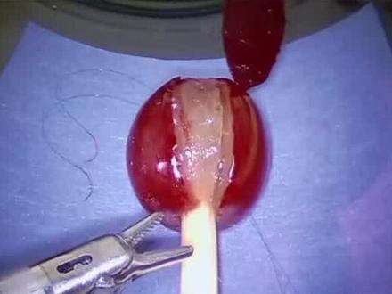 Intuitive Surgical是美国一家生产机器人手术系统的公司,公司最著名的产品是达芬奇外科手术系统。2000年7月,达芬奇(Da Vinci)机器人手术系统获得美国FDA批准,成为世界上第一个可以正式在手术室中使用的机器人手术系统。该系统以麻省理工学院(原名斯坦福研究学院)研发的机器人外科手术技术为基础。Intuitive Surgical随后与IBM、麻省理工学院和Heartport公司联手对该系统进行了进一步开发。视频中“达芬奇”机器人给小瓶子内的葡萄剥皮缝合,精细程度令人吃惊!#达芬奇机器人#daVinci#手术机器人#IntuitiveSurgical