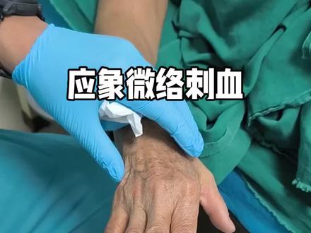 微络刺血治疗肢体凉