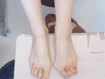 “食蚁啃脚” 双脚 竟然变了形 到底怎么回事? #拇外翻 #大脚骨 #类风湿 #女性 #脚