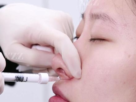 小剂量注射👃,拉出面中 #面中凹陷 #鼻小柱 #塌鼻子 #好看的侧脸 #注射隆鼻