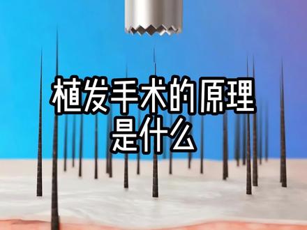 植发手术的原理是什么? 植发手术的原理是什么?#内容启发搜索 #种草激励计划 #植发手术
