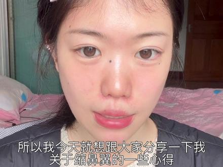 缩鼻翼心得分享#我的变美日记 #创作者中心 #创作灵感 #缩鼻翼