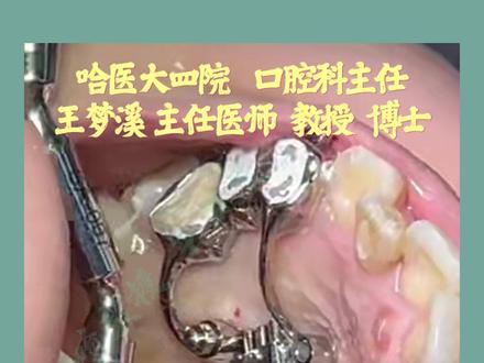 MSE、MARPE 骨性扩弓安装方法和注意事项 #抖出健康知识宝藏 #医院随拍 #牙医日常 #牙齿矫正 #勇敢的宝宝