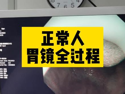 好多朋友至今很恐惧胃镜,希望这个视频能让大家更好的了解接受它