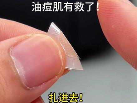 一定要扎进去!痘痘贴要用这种带刺的,战豆星人必备!#痘痘贴 #刺猬仔微晶痘痘贴 #痘痘 #亲测分享 #油痘肌