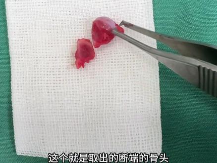 2个月小猫股骨颈骨折,手术取出断的股骨头在进行股骨颈切除,术后第二天就可以正常行走淘气了😏#铲屎官的日常 #股骨头切除 #猫骨折手术 #猫股骨头骨折 #股骨头坏死