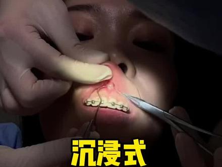 沉浸式换牙套钢丝,带你们听听温柔的声音#牙齿矫正 #牙套 #正畸 #钢牙贼帅 #牙齿 #沉浸式