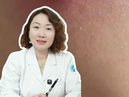 长了火疖子应该怎么处理?#火疖子 #医学小知识