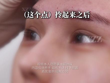 【do额头】提高面部折叠度,打造高级骨相 #面部折叠度 #额头窄 #额结节 #注射 #额头美学