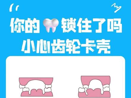 什么是🦷锁颌?要解锁,牙套如何帮忙? 矫正锁颌的目标是让上下牙回到和谐“搭档”的关系,建立正常的咬合轨道。常见的方式有:
➡️“撑开”空间型(扩弓)
➡️隐形牙套(透明牙套)
➡️传统托槽(金属/陶瓷牙套)
🌟关键点✨
🖊没有“最好”,只有“最适合”!选哪种方式(扩弓、隐形牙套、传统托槽)?这必须由专业的正畸医生根据你的年龄、锁颌的严重程度、类型、牙弓形态等具体情况,经过详细检查(拍片、取模)后才能给出个性化方案。
🖊早发现,早调整;青少年时期骨骼还有生长潜力,矫正可能相对更容易一些。
‼️专业评估是王道!牙齿矫正是个系统工程,锁颌更是需要精确处理。🚫千万别自己“对号入座”或随意购买矫正器哦!
#锁颌 #带牙套牙套的日子 #牙齿矫正 #科普一下 #爱牙护牙