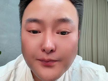 抗老紧致、保湿修护,温和适配多肤质。
核心功效
• 抗老紧致:促Ⅳ/Ⅶ型胶原与糖胺聚糖生成,强化真表皮连接,改善松弛、细纹与法令纹,提升轮廓感。
• 保湿锁水:增透明质酸合成,增强皮肤储水能力,缓解干燥、强化屏障。
• 修护维稳:抗炎抗氧化,减少自由基损伤,助力受损细胞修复,适配敏感肌与医美术后。
关键特点
• 温和安全:刺激性低,无需建立耐受,适合敏感肌及各类肤质。
• 浓度参考:常见3%-10%,10%浓度改善效果更明显。
• 搭配友好:可与胜肽、维C、烟酰胺等协同,提升抗老、提亮等效果。