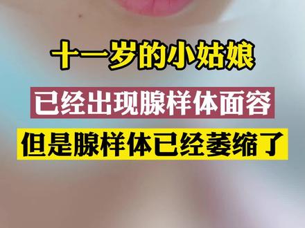 十一岁小姑娘,#腺样体面容 ,但#腺样体 已经萎缩了,治晚了!#耳鼻喉臧洪瑞 #医学科普 @抖音小助手