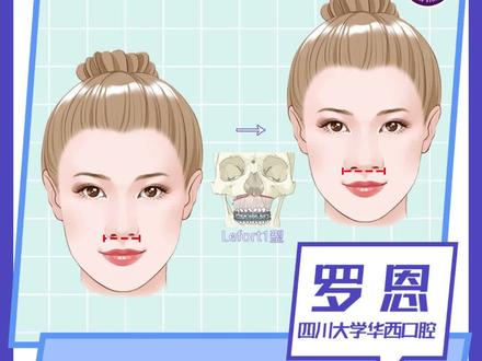 做上颌正颌手术,鼻子为什么会变宽?
#医学科普 #正颌 #嘴凸 #深覆合