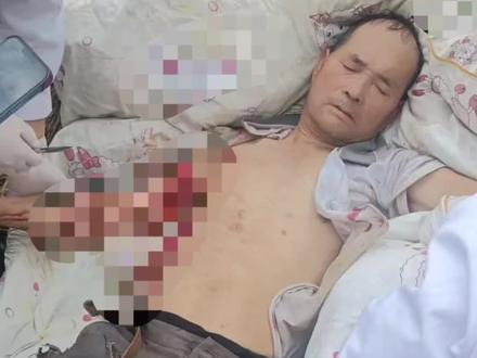 愿父亲平安顺遂,一切安好 #我要上热门
2026年4月9日,阳光明媚,我的心却始终悬在半空,一刻也无法放下。
昨天特意去医院探视父亲陈安康,看着他的状态,心里总算稍稍松了口气。之前截肢手术的伤口愈合得很不错,这是这段时间以来,为数不多能让我感到宽慰的事。可即便如此,父亲腹腔依旧还有些胀气,看着他难受的模样,我心底的紧张与担忧丝毫没有消减,始终揪得紧紧的,满心都是心疼。
今早,我特意找到父亲的主治医生,仔细询问了后续的治疗方案,得知明天就要进行肋骨骨折以及胸腔肺部的修复手术。听完医生的话,心里更是五味杂陈,有忐忑,有不安,更多的是满心的祈愿,只盼着这场手术能够顺顺利利,父亲能平平安安地度过这一关。
父亲是土生土长的农村人,一辈子做着一名平凡的草医生。在乡里乡间,谁提起父亲,都会竖起大拇指。他这一生,凭借着自己的医术,医治好了无数断手断脚、关节脱臼的乡亲,帮多少人摆脱了病痛的折磨,拯救了无数个因为家人受伤而濒临破碎的家庭。可最难能可贵的是,他从来没有收取过任何一位病人的医药费,始终凭着一颗善心,默默为身边的人排忧解难。
有时候静下心来想想,父亲这一生行善积德,治病救人,不求分毫回报,用自己的微薄之力,温暖了那么多陌生人,这一桩桩、一件件,何尝不是积德行善?他用一辈子的善良与坚守,诠释着医者仁心,即便没有惊天动地的壮举,却在乡邻心中留下了数不尽的温暖。
此刻,我别无所求,只希望上天能眷顾善良的父亲,让明天的手术一切顺利,让他少受些病痛的折磨,早日康复起来。只要父亲能平安健康,便是我此刻最大的心愿。