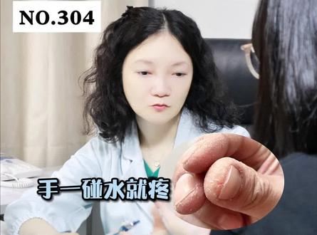 老婆手指头干燥粗糙,有小裂口,不能做家务,可不是矫情,这是#角化型湿疹 #科普 #夫妻 #皮肤 #肝素钠乳膏