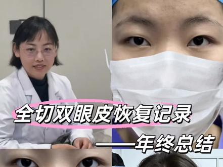 双眼皮年终总结来啦#南京双眼皮#江苏双眼皮#南京王苗苗