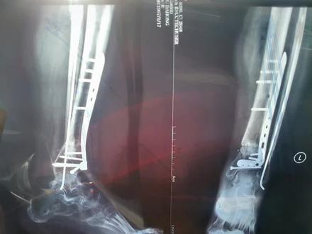 今天去医院复查了,长骨痂了,还得一段时间康复。骨折路好漫长呀