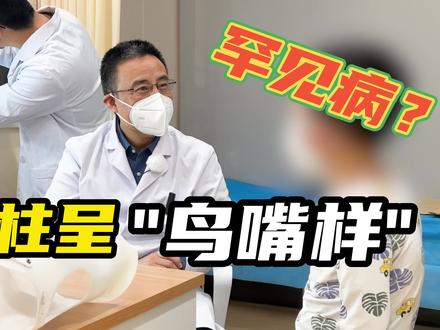 男孩脊柱呈"鸟嘴样"?医生怀疑孩子得了罕见病!#脊柱侧弯 #青少年健康 #社会百态