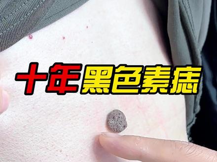 十年黑色素痣#医学科普仅供参考如有不适请线下就医 #医学科普 #黑色素痣 #胃肠专家张万福教授 #医者仁心