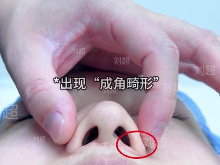 为什么“滑行皮瓣”能改变宽大的鼻翼形态? #无假体鼻#滑行皮瓣#鼻翼缩小 #大鼻头缩小 #鼻头缩小