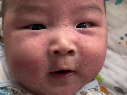 严重湿疹之后,医生这么说