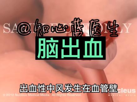 1分钟了解脑出血!#脑出血 #卫健委 #河南大学 #大三女生脑出血 #脑出血 #120 #3d动画 #急救