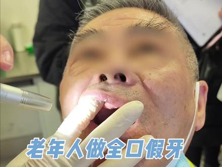 老年人做全口假牙前,尖锐的骨尖要处理好。#口腔健康 #全口假牙 #口腔肿瘤