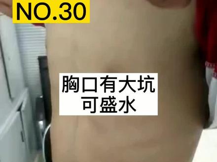 胸口有坑能盛水,千万不要过分补钙,效果一般,要找专业医生评定确定治疗方案!#医学科普 #十万个怎#漏斗胸