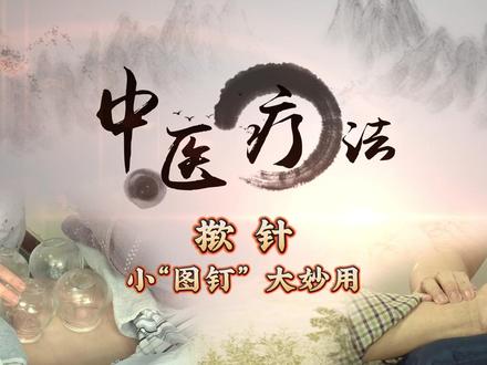 #揿针,又称为揿针型皮内针,是临床皮内针的常见类型。揿针是针对需针灸治疗,但畏针、怕针的人群研制而出。具有安全、方便、舒适、无痛,治疗范围广的特点。
#中医疗法 #广州白云