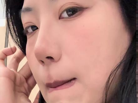 人中窝三个月 #人中窝加深 #嘴角上扬