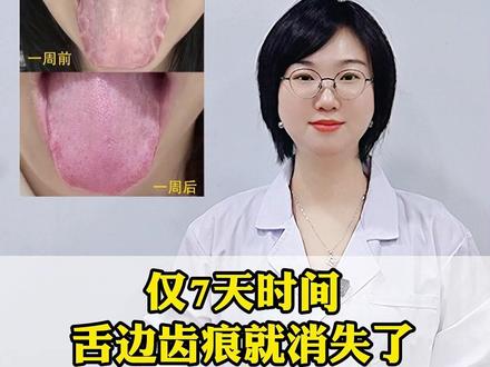 仅7天时间,舌边齿痕就消失了,可别再说湿气、齿痕难除了#中医 #舌诊 #医学科普 #抖出健康知识宝藏 #我的年度健康盘点