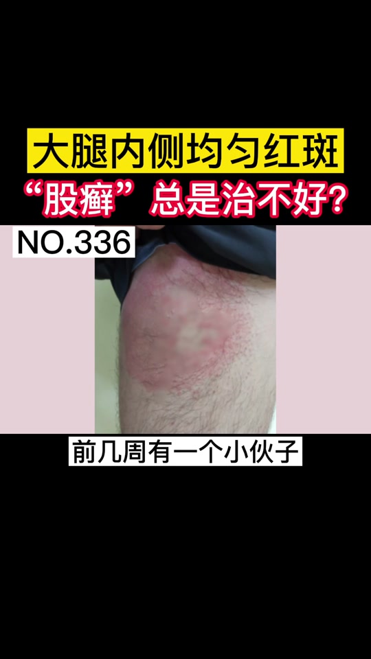 股癣留下的黑色素怎么去除_股癣怎么样才算治好了_股癣留下的黑色素