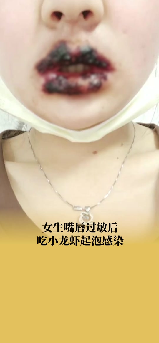 女生闻到小龙虾气味过敏全身发红 - 抖音