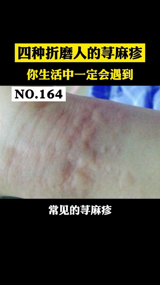 胆碱性荨麻疹使我活的像个吸血鬼 - 抖音