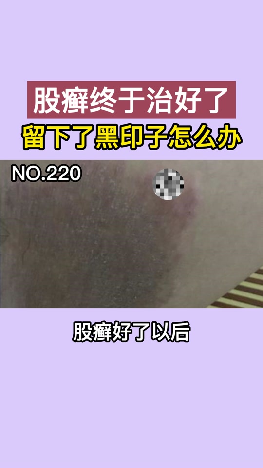 股癣留下的黑色素怎么去除_股癣怎么样才算治好了_股癣留下的黑色素