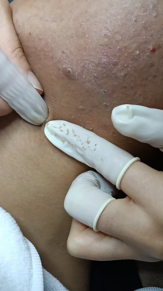 抖音看挤痘=抖音挤痘痘视频可以赚钱吗