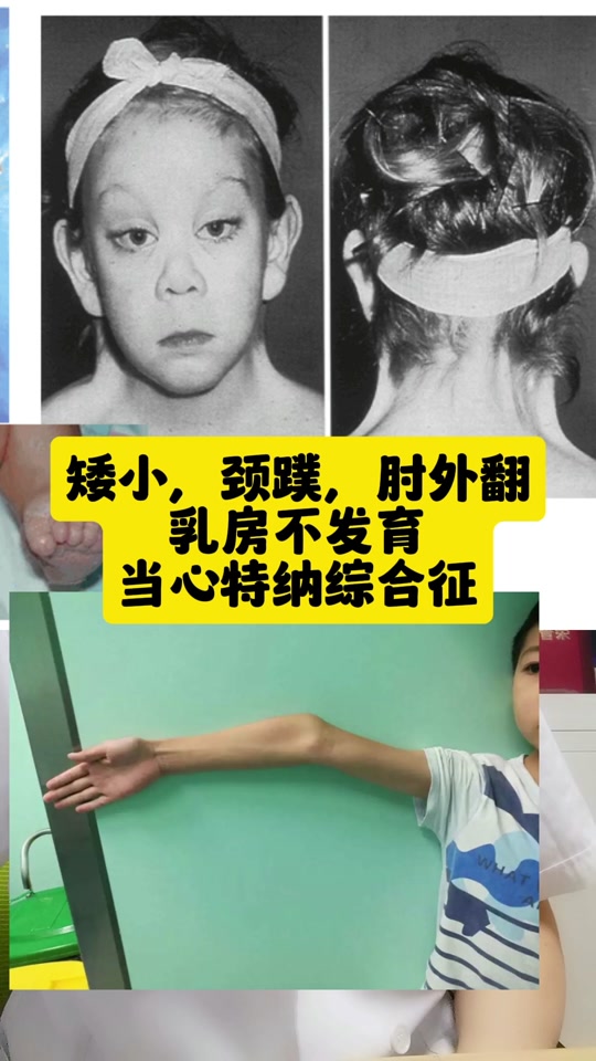 当心#特纳综合征