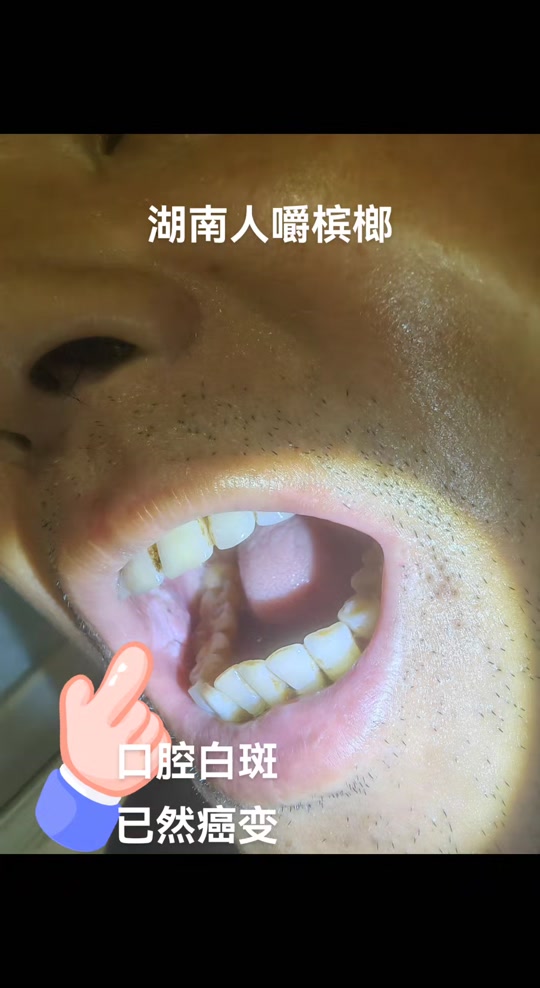 口腔出现3种异样警惕口腔癌
